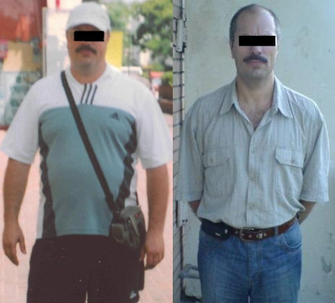 Пациент до и после лечения. Похудел на 36 кг за 8 месяцев