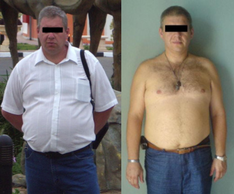 Пациент до и после лечения. Похудел на 39 кг за 7 месяцев