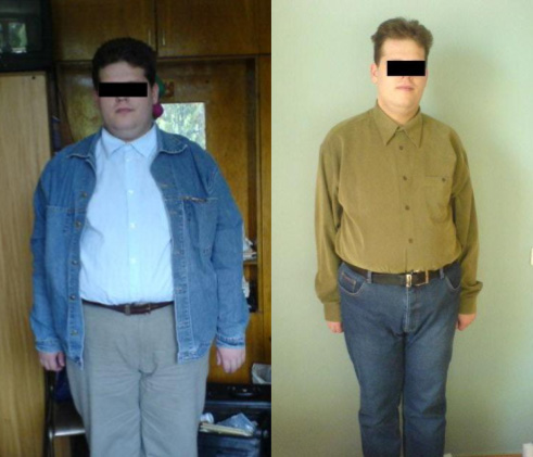 Пациент до и после лечения. Похудел на 39 кг за 6 месяцев