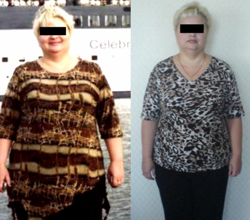 Пациентка до и после лечения. Похудела на 24 кг за 5 месяцев.
