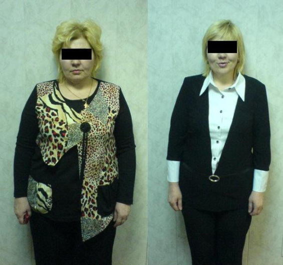 Пациентка до и после лечения. Похудела на 18 кг за 4 месяцев.