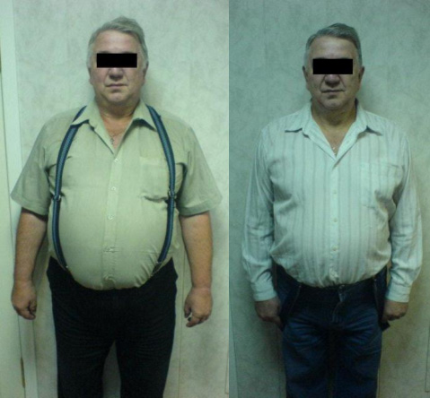 Пациент до и после лечения. Похудел на 32 кг за 6 месяцев
