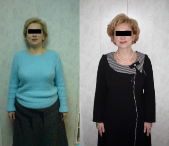 Пациентка Н., 41 год. До и после лечения. Похудела на 21 кг за 8 месяцев.