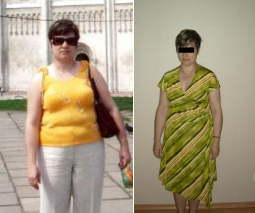 Пациентка Н., 39 лет. До и через 6 месяцев  лечения. Похудела на 18 кг. Через 2 года сохраняет достигнутый вес. 