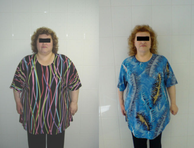 Пациентка Н., 46 лет, до и после лечения.