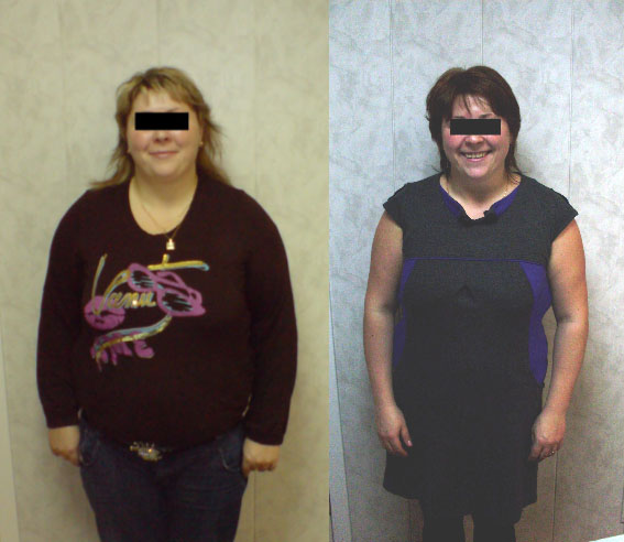 Пациентка С., 29 лет. До и через 6 месяцев  лечения. Похудела на 28 кг.