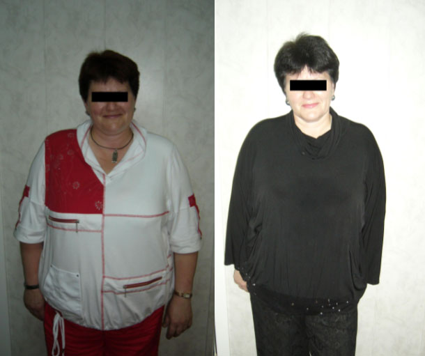 Пациентка В., 45 лет. До и через 5 месяцев  лечения. Похудела на 28 кг.
