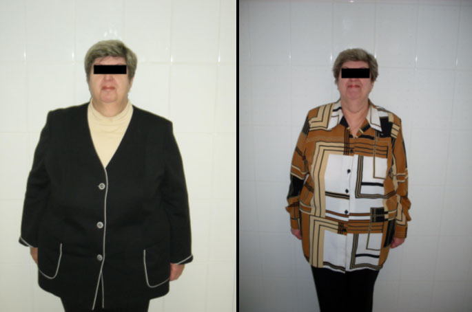 Пациентка Н., 62 лет. До и через 5 месяцев  лечения. Похудела на 19 кг. Продолжает худеть.
