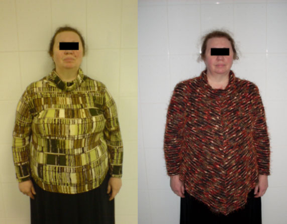 Пациентка К., 53г. Вес 108кг, ИМТ 51%. Через 6 месяцев вес 89 кг (похудела на 19кг). Продолжает худеть.