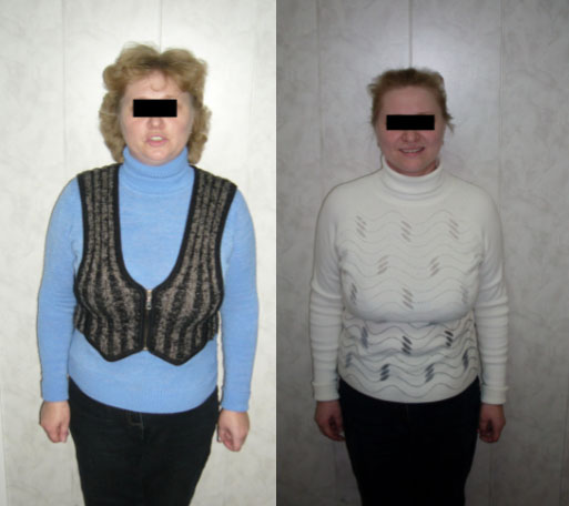 Пациентка В., 45 лет. До и через 4 месяцев  лечения. Похудела на 18 кг. Через год сохраняет достигнутый вес. 